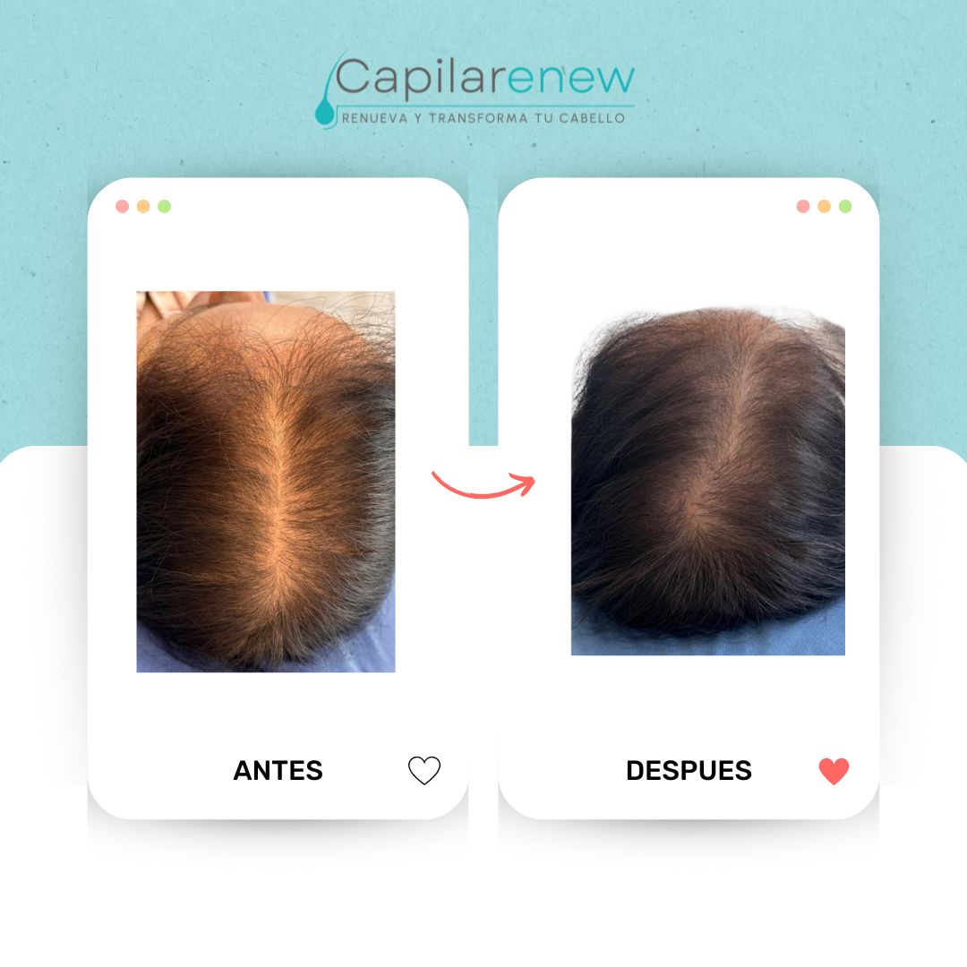 Antes y Despues tonico capilar